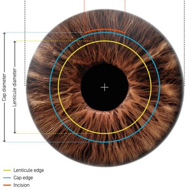 schwind_smartsight